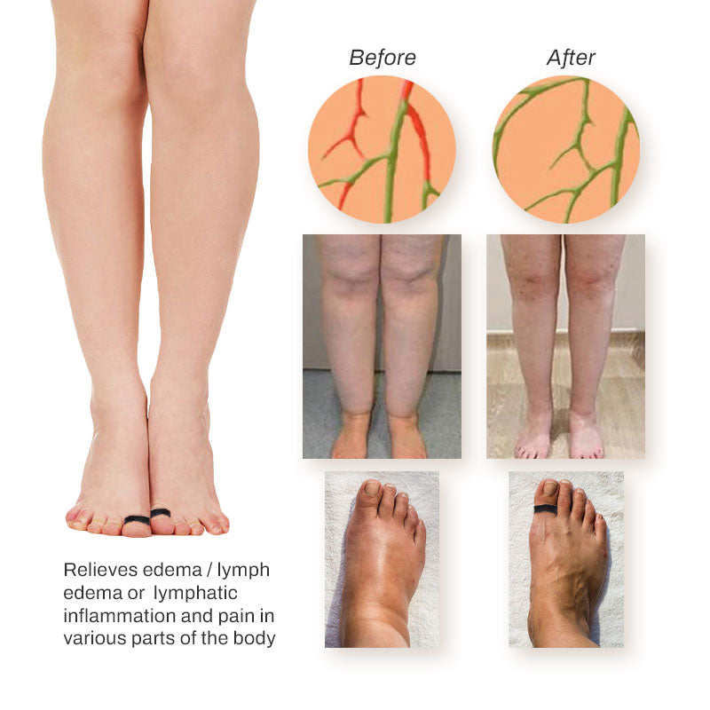 ProAcupoint SwellReduce LymphDetox ToeRing