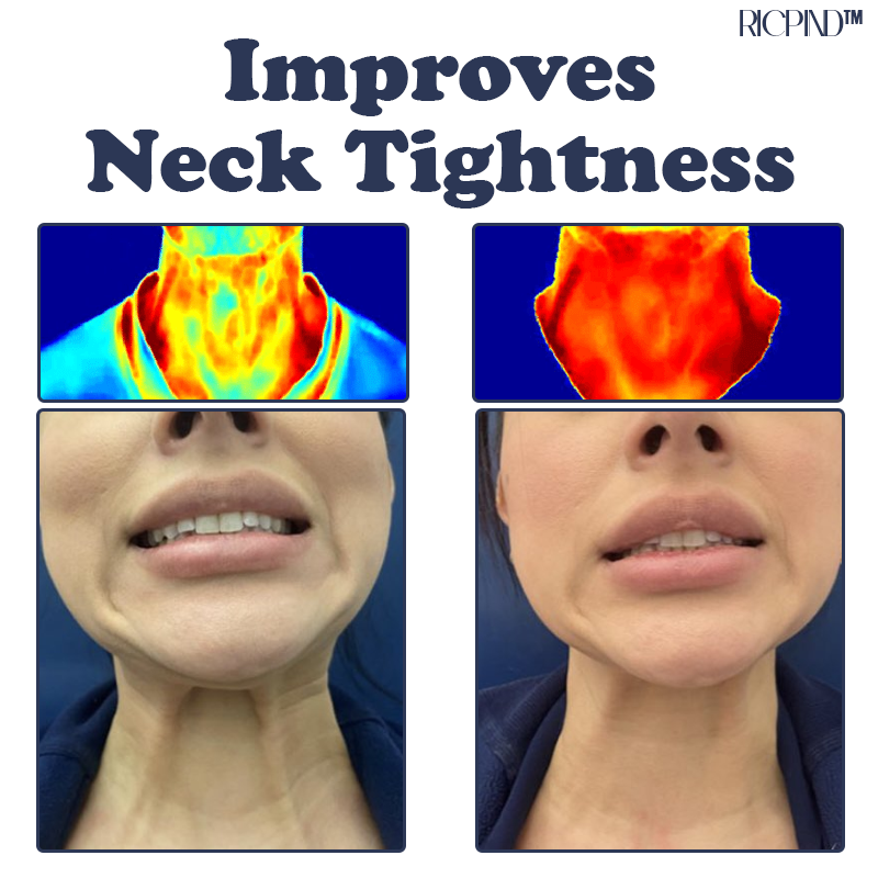 RICPIND IONIC Therapy NeckPain ReliefPad