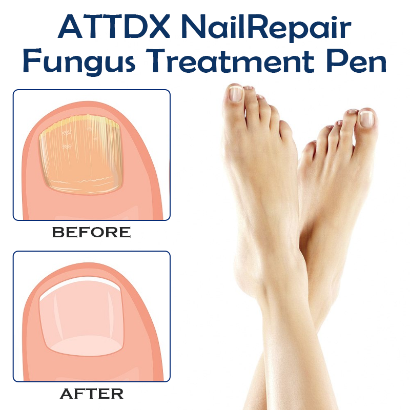 ATTDX NailRepair Fungus Treatment Pen