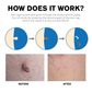 ATTDX AutoRemove SkinTag Kit
