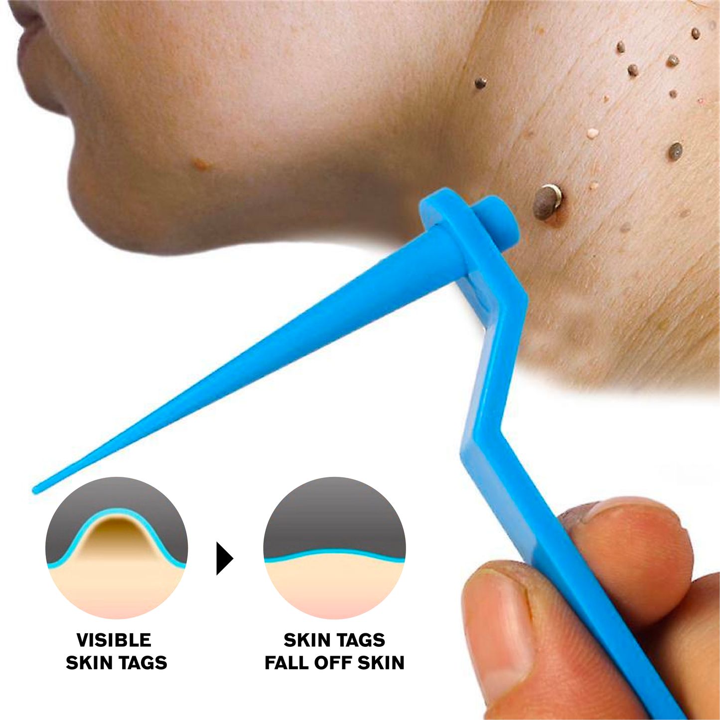 ATTDX AutoRemove SkinTag Kit