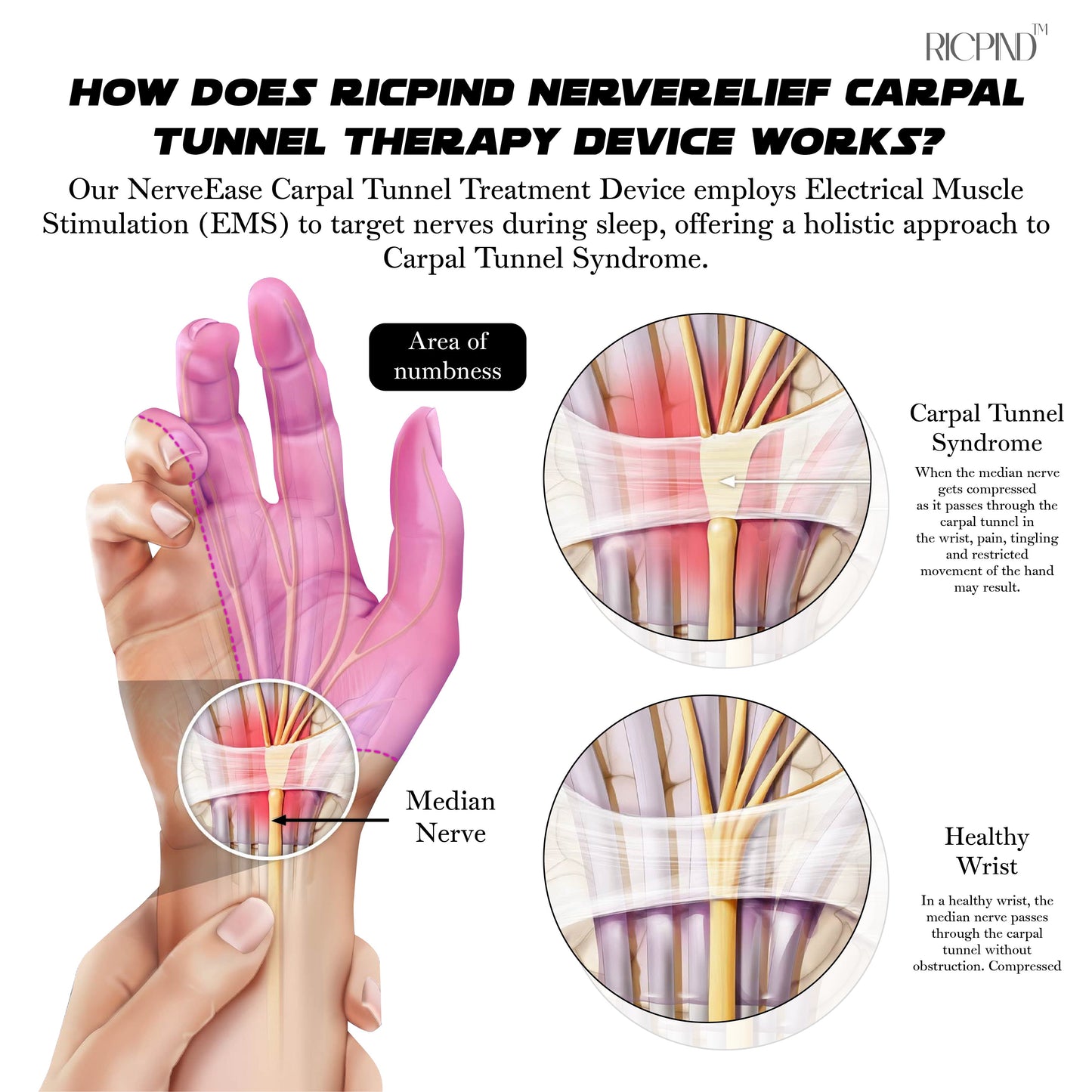 RICPIND NerveRelief Carpal Tunnel Therapy Device