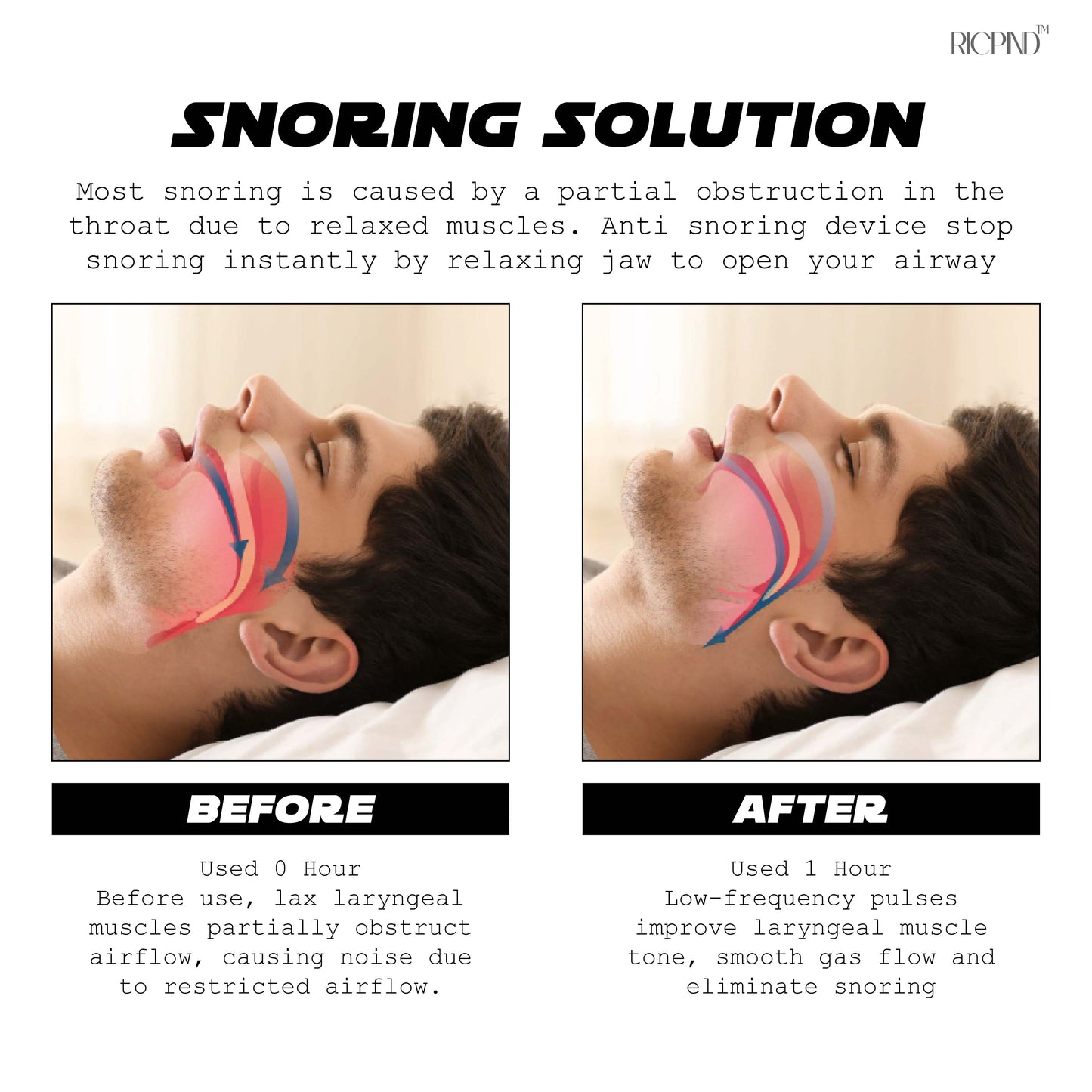 Ricpind AI Instant SnoringReduction Vibrating Stopper